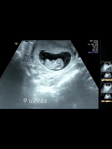Understanding Your Baby at 9 Weeks Pregnant