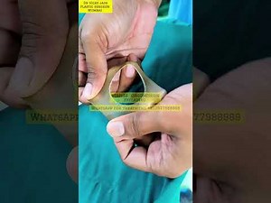 How ZSR Stapler Circumcision is done? Demo on Dummy Model #CIRCUMCISION #ZSR #drvickyjain #simula...