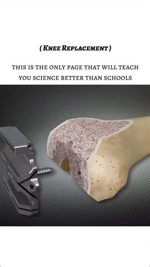 Knee Replacement: How Modern Medicine Restores Movement