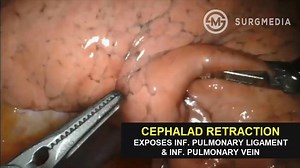Operative Retraction Techniques for Robotic Pulmonary Lobectomy Basic techniques of retraction for optimal exposure during Robotic Pulmonary Lobectomy. Credit: Robotic Thoracic Surgery | SurgMedia