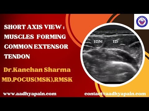 Ultrasound: Short Axis View: Muscle Forming Common Extensor Tendon