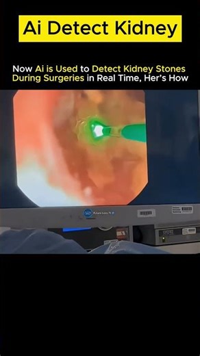 AI Helps Detect KIDNEY STONES Quickly And Accurately?