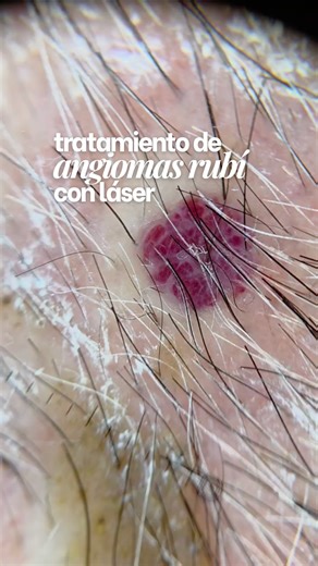 Dr. Pablo Pagano | Dermatólogo en Neuquén on Instagram: "Los angiomas rubí pueden cambiar de color inmediatamente después del tratamiento con láser, y eso es totalmente esperable. En este caso utilicé láser Chrome para coagular selectivamente el vaso. 👉🏻 Primero se ve rojo, por la respuesta vascular inicial. 👉🏻 Luego aparece el tono más oscuro/negro, señal de que el vaso ya fue tratado y está en proceso de resolución. En los próximos días, el color irá disminuyendo hasta desaparecer. Este ti