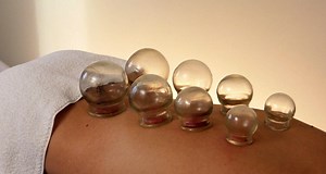 Inside cupping: the therapy that's left celebs with sore-looking red marks