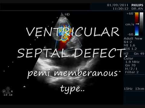 VSD-Peri membranus Type. ECHOCARDIOGRAPHY SERIES BY DR ANKUR K. CHAUDHARI