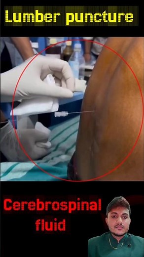 Lumber puncture #csfextraction #cerebrospinalfluid #braindisorder