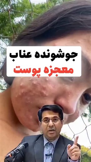 ‎سیگنال جوانی | لک و چروک | کرم جوانه گندم | بوتاکس | خسرو زارع‎ on Instagram‎: "جوش نزن👇🏻❌️ 😱 جوش فقط یه دونه روی صورت نیست! هر جوش می‌تونه یواش‌یواش اعتماد به نفستو بخوره… 🍂 وقتی بدن به‌هم می‌ریزه، پوست اولین جاییه که اعتراض می‌کنه. 🌿 از درون که آروم‌تر بشی، بیرونم راه میاد… تو طب سنتی، عناب به پاکسازی بدن و کاهش التهاب معروفه ✨ و کنار مراقبت درونی، پوستت به یه کمک درست از بیرون هم نیاز داره 👇🏻 🧴 کرم جوانه گندم یه کرم همه‌کاره برای وقتی که پوستت خسته، خشک، ملتهب یا حساسه 💔 ✔️ ضدچروک ق