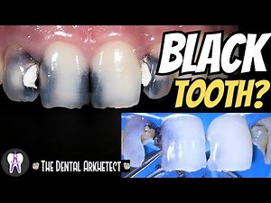 Restoring An Endodontically Treated Teeth.. #C69 #4k