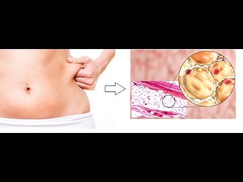 Rigenerare la cartilagine del ginocchio con cellule staminali adipose (Lipogems).Dr Vinicio Perrone.