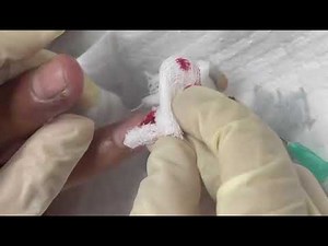 Finger Abscess with greenish pus