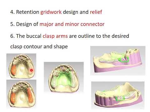 Digitally Designed & Fabrication Process of RPD Framework Using CAD/CAM System