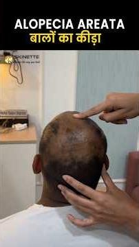 What is Alopecia Areata Treatment & Hair Regrowth: What Actually Works #hairgrowth #alopecia