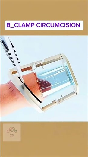 HOW T #Bclampcircumcision #Circumcision #MaleCircumcision #HealthAndHygiene #DisposableCircumcision