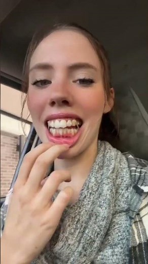 Week 1 to week 11 with invisalign