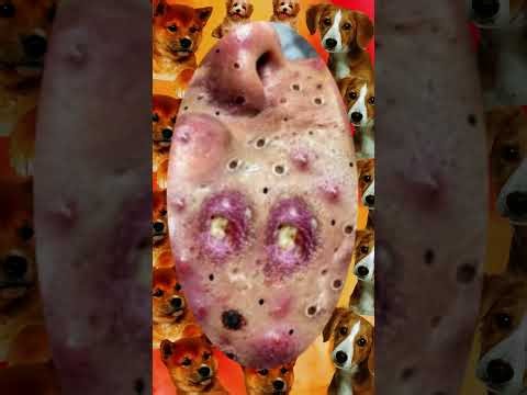 Blackheads Removal #538 | Acne Treatment and Very Satisfying Satisfying Pimple pop #blackheads