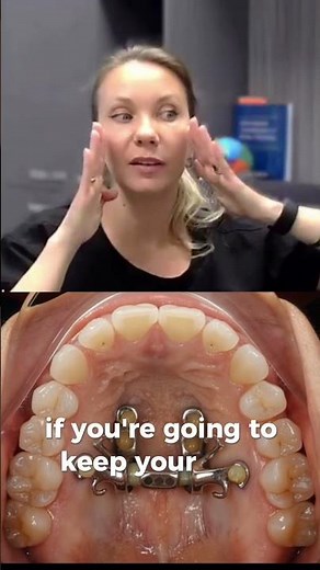 MARPE Asymmetries Part II. Molar Inclination explained