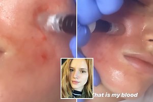 Bella Thorne left with bloodied face after skincare treatment to remove acne