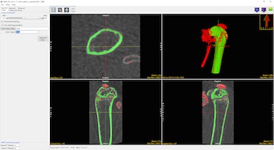 BMA: Bone Microarchitecture Analysis Add-On - AnalyzeDirect