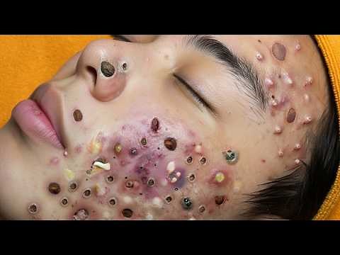 Loan Nguyen Acne Treatment 11gg