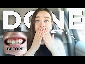 I finally got my Invisalign removed!! INVISALIGN JOURNEY UPDATE