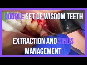 Unusual Case: Extra Wisdom Teeth in Upper Jaw - Surgical Removal and Oroantral Communication Closure • Video • MEDtube.net