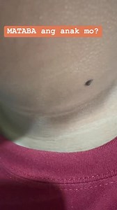 Nangingitim ba ang leeg at kili kili ng anak mo?Hindi po libag yan, ang tawag diyan ay ACANTHOSIS NIGRICANS- isang senyales ng insulin resistance na nakikita sa mga matatabang bata na sa kalaunan ay nagkakaroon ng diabetes! 😍 #docirma #diabetes #type2diabetes #obese #overweight | Irma Antonio-Pilar MD/ Diabetes and Thyroid Specialist