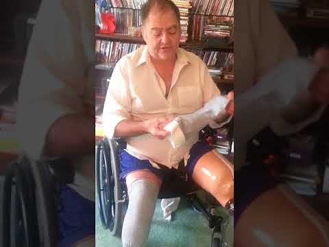 103 how to fix my extremely swollen stump--BKA amputee