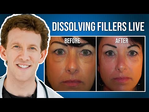 Dissolving Under Eye Fillers | Live Procedure