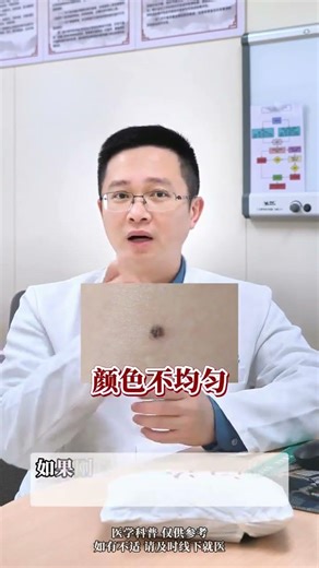 Is Your Mole a Hidden Cancer Risk? Uncover the Truth