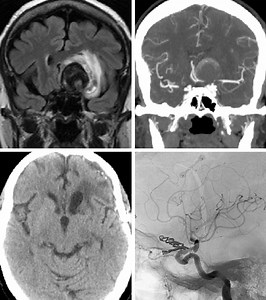 Anterior Circulation Aneurysms: Clip or Coil? | Cohen Collection | Volumes | The Neurosurgical Atlas