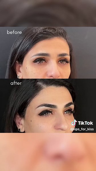 Botox brow lift in our signature technique This procedure works by relaxing the muscles that pull the brows downward, allowing the muscles that lift the brows to work more effectively 💉 As a result, the brow area looks smoother and more open, reducing the appearance of wrinkles and fine lines 📍Moscow | Dubai | London appointments available Schedule an appointment with one of our talented aesthetic doctors 💻 https://lfk-academy.com #recommendations #cosmetology #fyp #fashion #estetik #lipfille