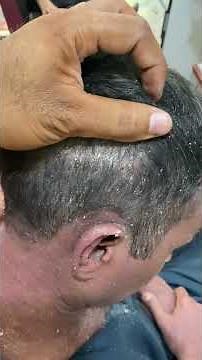 How to get rid old dandruff flakes scratching with comb removal
