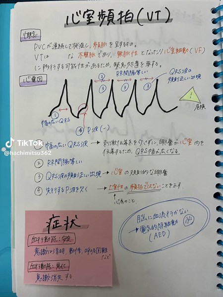 心電図第3弾🫀やっぱ心電図はちょー難しいけどめげずに頑張ろっと🤨#心電図#VT #心室頻拍 #心房細動 #VF #心室細動 #洞不全症候群 #勉強ノート #PT学生