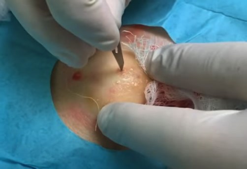 Juicy Sebaceous Cyst Explosion