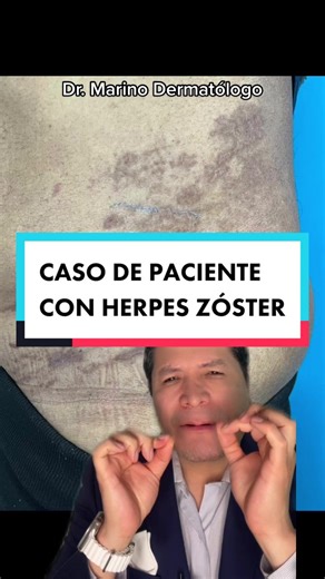 Qué es y cómo tratar la herpes zóster efectivamente