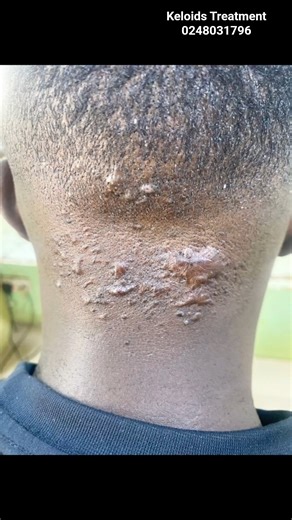 Keloid Treatment Without Surgery | Safe & Effective #affordabletreatment #clinic