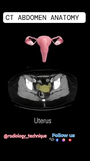 CT Abdomen Anatomy #radiographer #medicogirl #insta #imaging #reels #xraytech #radiologia #bone #xrays #disorder #ctscanner #medicos #medico #mbbs #mbbsstudent #Abdomen | Diwakar Patel