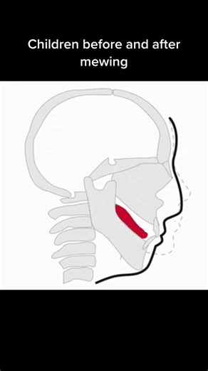 Transformation of Children Before and After Mewing