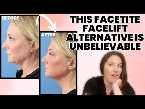 What Getting a FaceTite "Liquid Facelift" REALLY Looks Like (Full Procedure)