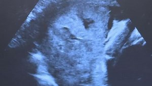 How to Deal With Placenta Abruption While Pregnant