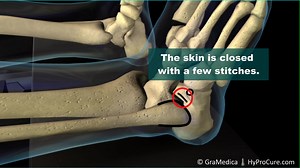 630 reactions · 15 shares | Dr. Pasquale Cancelliere -Effective Treatment for Posterior Tibial Tendon Disease/ Painful Flat Foot #hyprocure #pediatrics #flatfeet #flatfoot #heelpain #plantarfasciitis #momstagram #myfeetarekillingme #orthotics #orthotic #insoles #archsupport #anklepain #overpronation #hippain #backpain #kneepain #supination #5k #fallenarches #podiatrist | HyProCure | Facebook