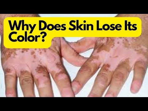What Causes Vitiligo? | Understanding the Science Behind Skin Pigment Loss