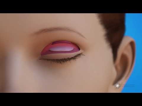 How is ptosis repair surgery done in children?