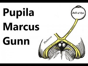 Defecto Pupilar Aferente