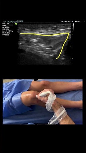 Normal Knee Ultrasound: Discover what it looks like! 🦵
