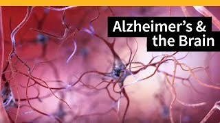 How Alzheimer's Disease Changes the Brain