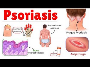 Psoriasis EXPLAINED SIMPLE and CLEAR!