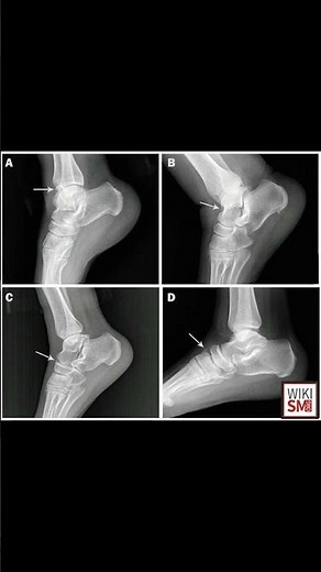 🦴 Os Talotibiale – Rare Ankle Accessory Bone Explained!