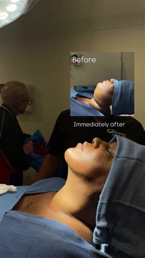 Chin Lipo and JPlasma for a Sculpted Jawline