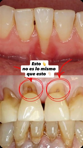 Dr Federico Baena Q on Instagram: "La diferencia entre encías retraídas y desgaste en el cuello de los dientes. Es importante reconocerla para saber el tratamiento adecuado."